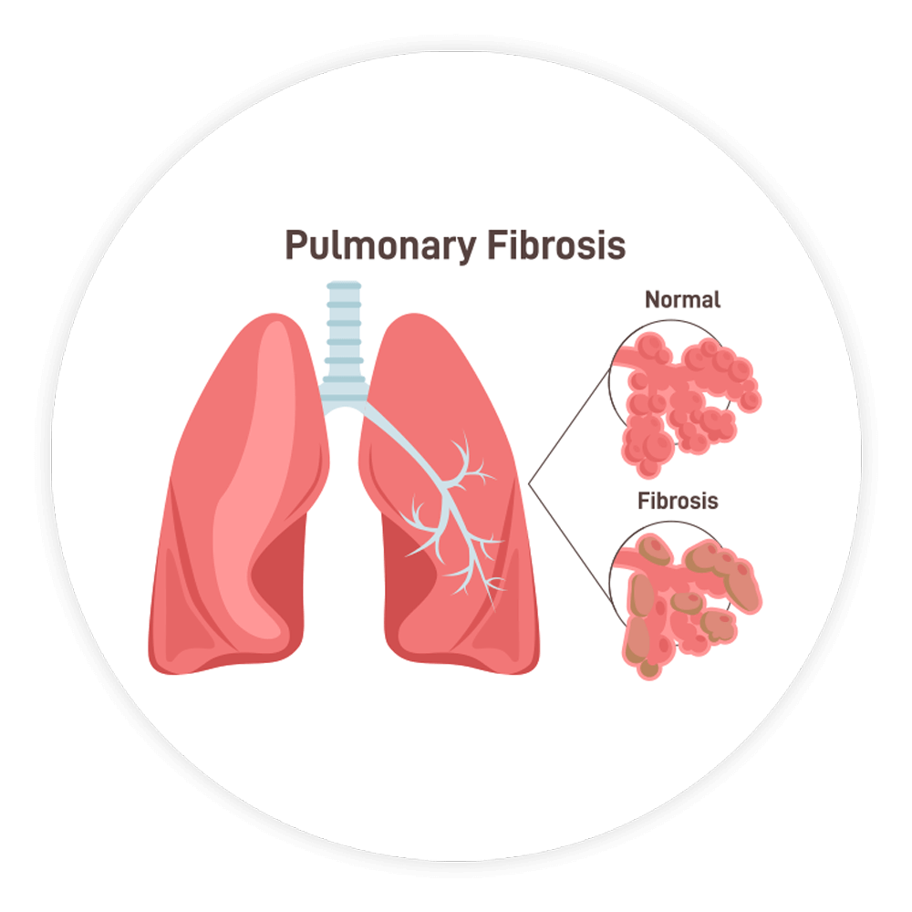 Schéma Fibrose Pulmonaire